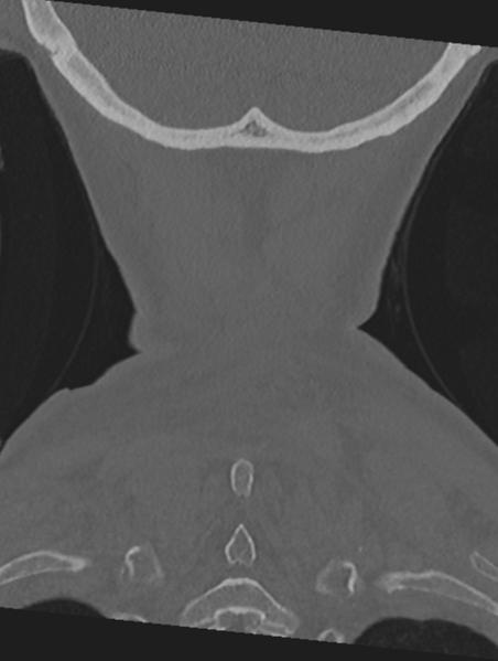 File:Cervical spondylolysis (Radiopaedia 49616-54811 Coronal bone window 59).png