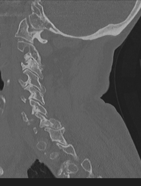 File:Cervical spondylolysis (Radiopaedia 49616-54811 Sagittal bone window 49).png
