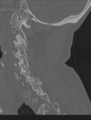 Cervical spondylolysis (Radiopaedia 49616-54811 Sagittal bone window 49).png