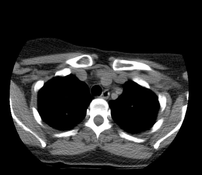 File:Cervical venous malformation (Radiopaedia 22653-22672 Axial non-contrast 55).jpg