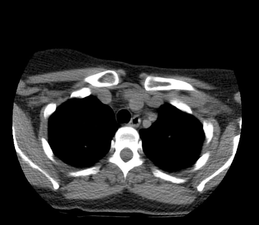 Cervical venous malformation (Radiopaedia 22653-22672 Axial non-contrast 55).jpg
