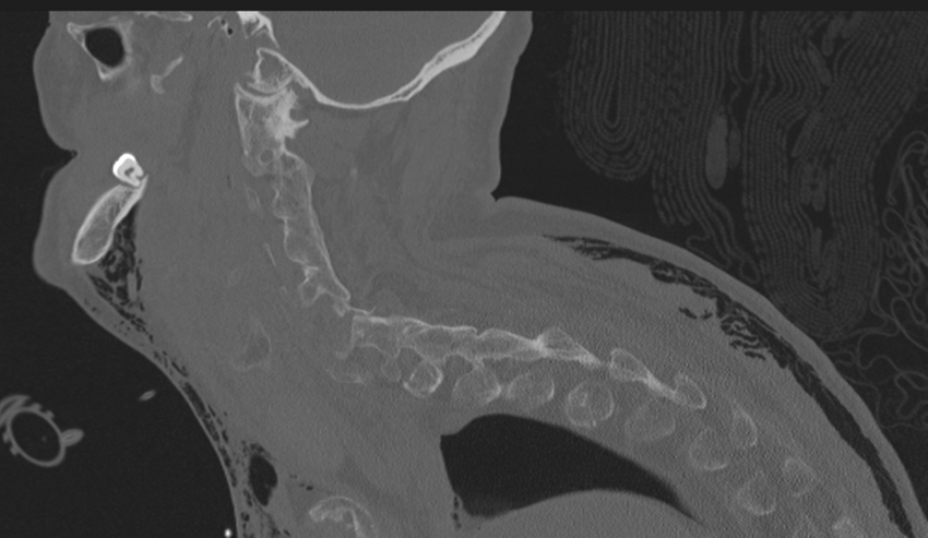 Chalk stick fracture (Radiopaedia 57948-64928 Sagittal bone window 18).png