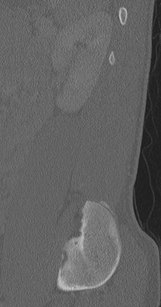 File:Chance fracture (Radiopaedia 40360-42912 Sagittal bone window 16).png