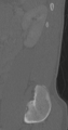 Chance fracture (Radiopaedia 40360-42912 Sagittal bone window 16).png