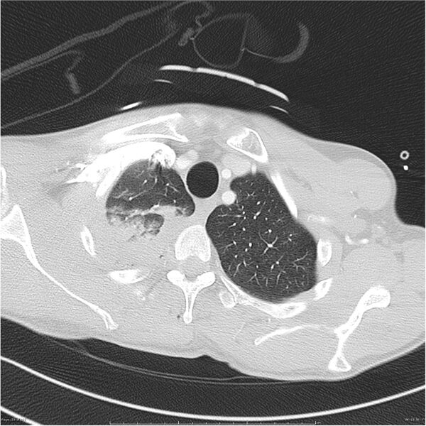 File:Chest and abdomen multi-trauma (Radiopaedia 26294-26425 lung window 23).jpg