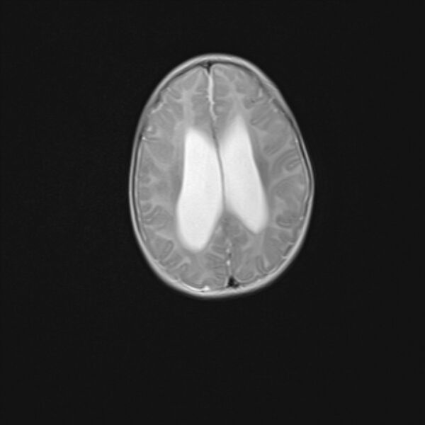 File:Chiari III malformation with occipital encephalocele (Radiopaedia 79446-92559 Axial T2 19).jpg