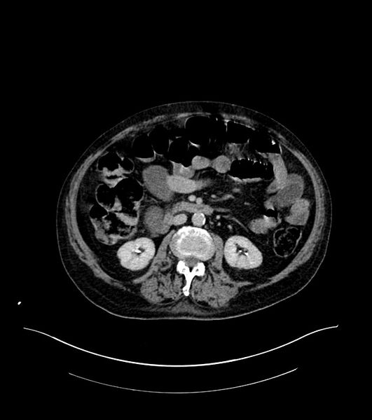 File:Cholangiocarcinoma with cerebral metastases (Radiopaedia 83519-98629 Axial C+ delayed 56).jpg