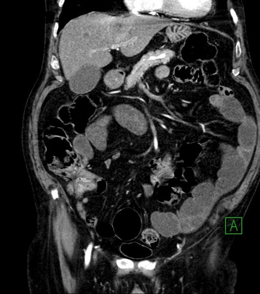 File:Cholangiocarcinoma with cerebral metastases (Radiopaedia 83519-98629 E 35).jpg
