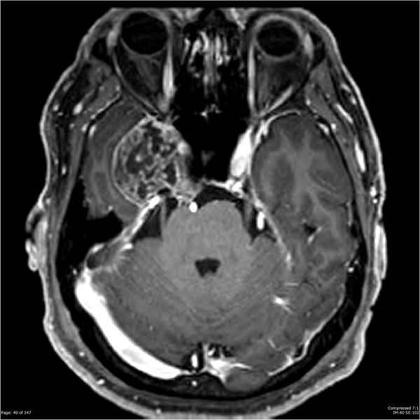 File:Chondrosarcoma of skull base- grade II (Radiopaedia 40948-43654 Axial T1 C+ 28).jpg