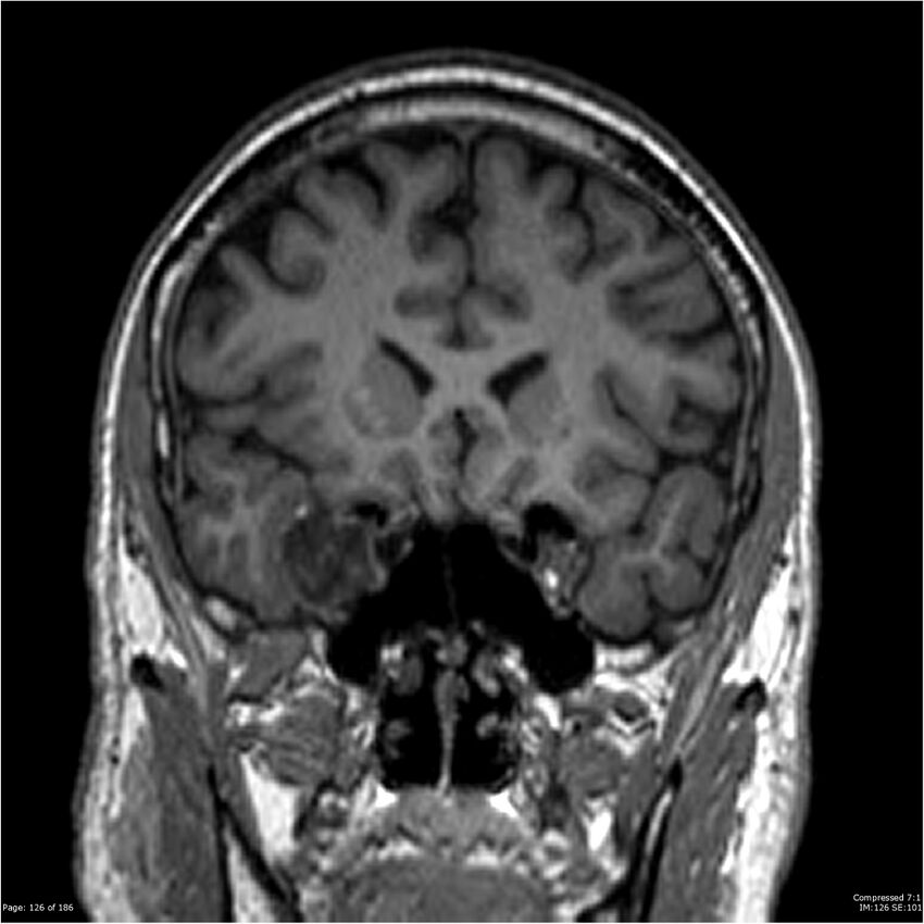 Chondrosarcoma of skull base- grade II (Radiopaedia 40948-43654 Coronal T1 47).jpg