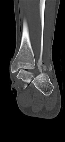 File:Chopart fracture (Radiopaedia 35347-36851 Coronal bone window 27).jpg