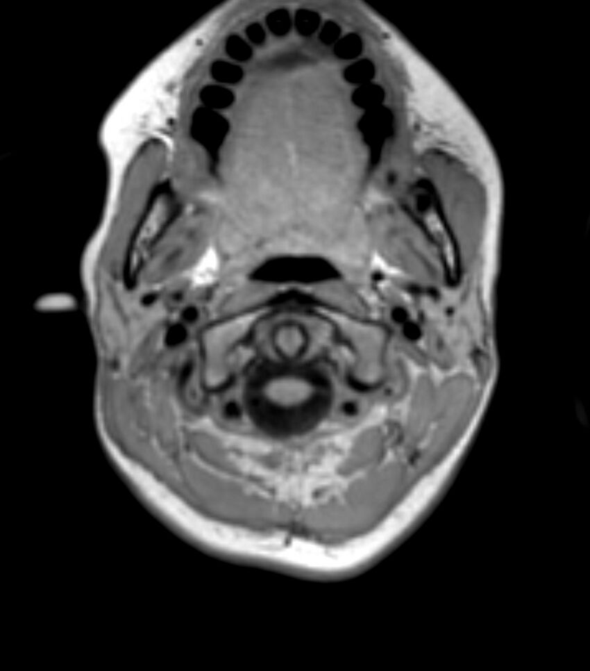 Choroid plexus carcinoma (Radiopaedia 91013-108553 Axial T1 17).jpg