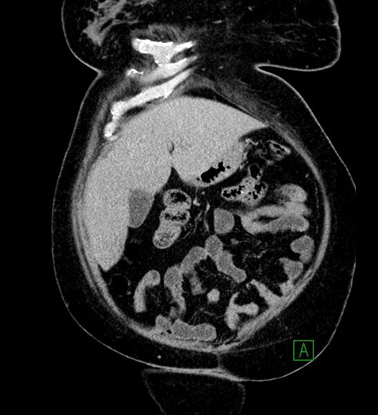 File:Chromophobe renal cell carcinoma (Radiopaedia 84239-99519 F 21).jpg