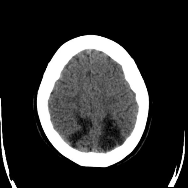 File:Chronic bilateral occipital lobe infarcts (Radiopaedia 31276-31996 Axial non-contrast 34).jpg