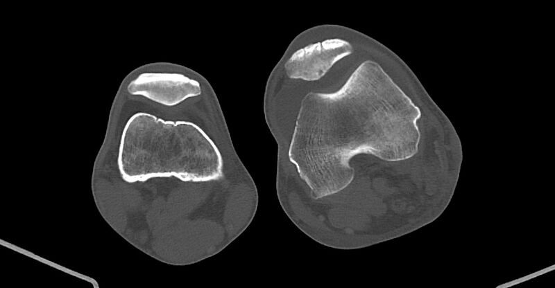 File:Chronic osteomyelitis (with sequestrum) (Radiopaedia 74813-85822 Axial non-contrast 180).jpg