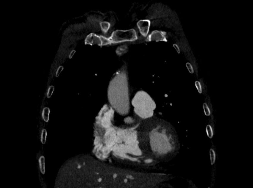 Chronic pulmonary embolism (Radiopaedia 91241-108843 A 21).jpg