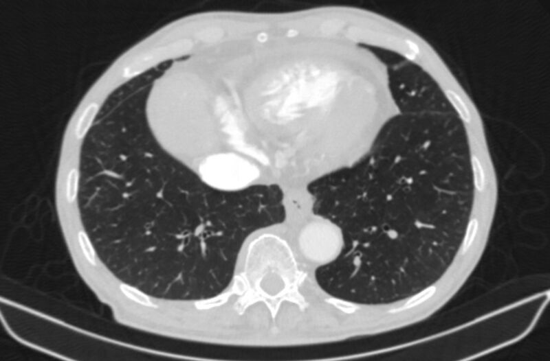 File:Chronic pulmonary embolism (Radiopaedia 91241-108843 Axial lung window 72).jpg