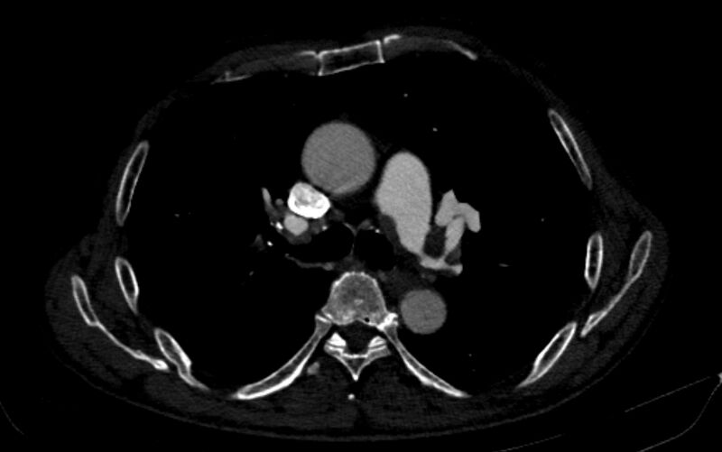 File:Chronic pulmonary embolism (Radiopaedia 91241-108843 B 78).jpg