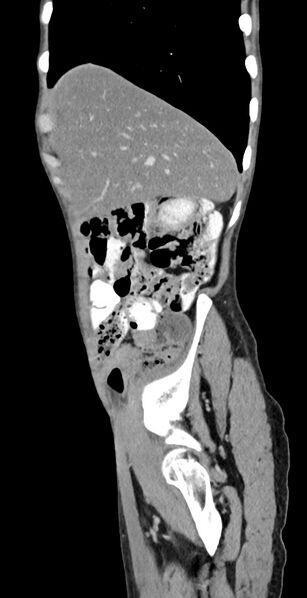 File:Chronic small bowel volvulus (Radiopaedia 75224-86322 C 119).jpg