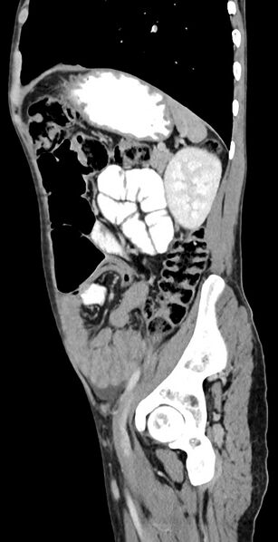 File:Chronic small bowel volvulus (Radiopaedia 75224-86322 C 45).jpg