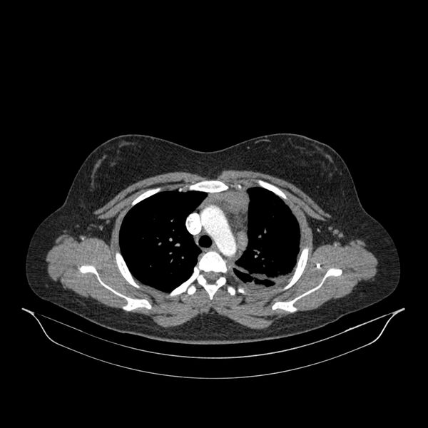 File:Chronic thromboembolic pulmonary hypertension (CTEPH) (Radiopaedia 74597-85532 Axial C+ CTPA 115).jpg