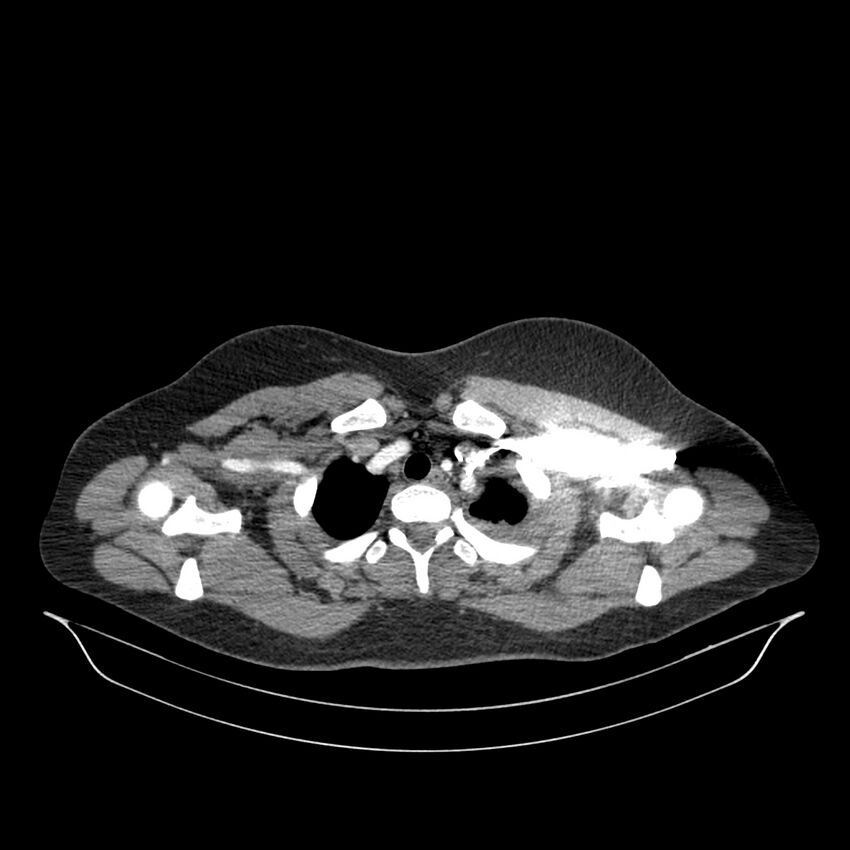 Chronic thromboembolic pulmonary hypertension (CTEPH) (Radiopaedia 74597-85532 Axial C+ CTPA 143).jpg