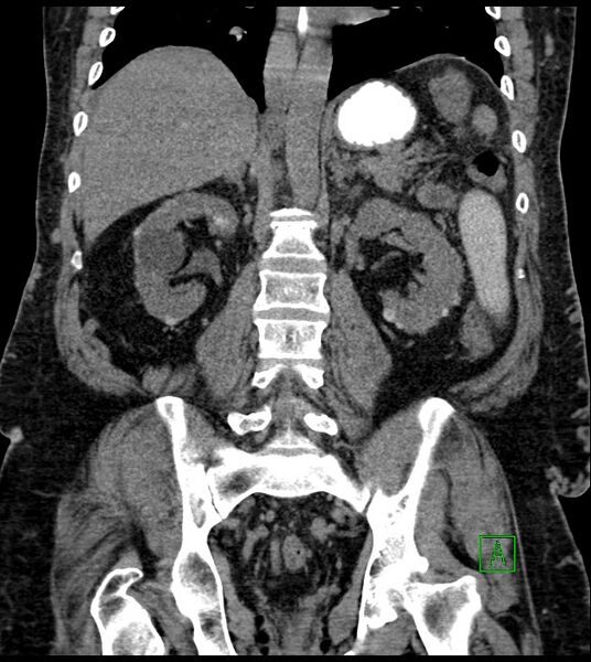 File:Closed-loop small bowel obstruction-internal hernia (Radiopaedia 78439-91096 Coronal non-contrast 67).jpg