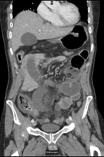 File:Closed loop bowel obstruction and ischemia (Radiopaedia 86959-103180 B 13).jpg