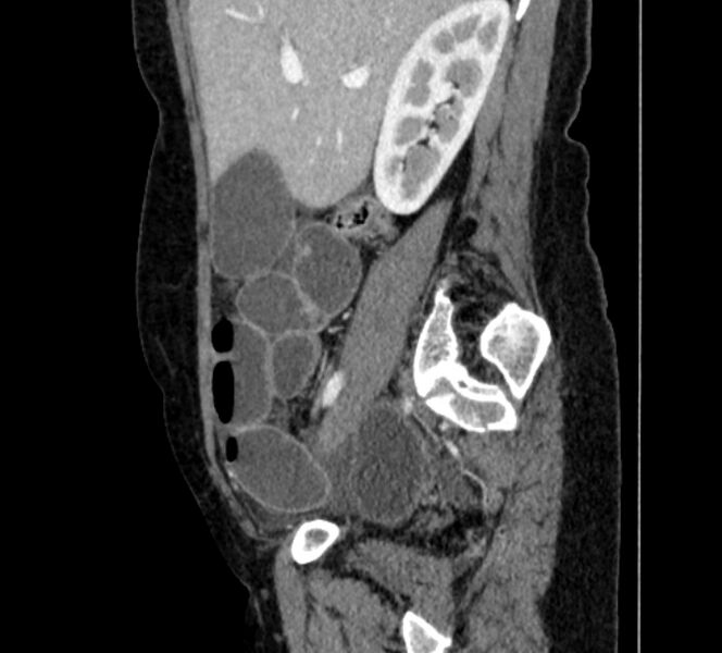File:Closed loop small bowel obstruction (Radiopaedia 71211-81508 C 34).jpg