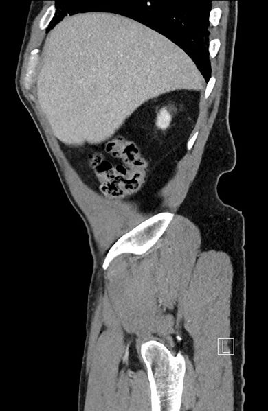 File:Closed loop small bowel obstruction - internal hernia (Radiopaedia 57806-64778 C 94).jpg