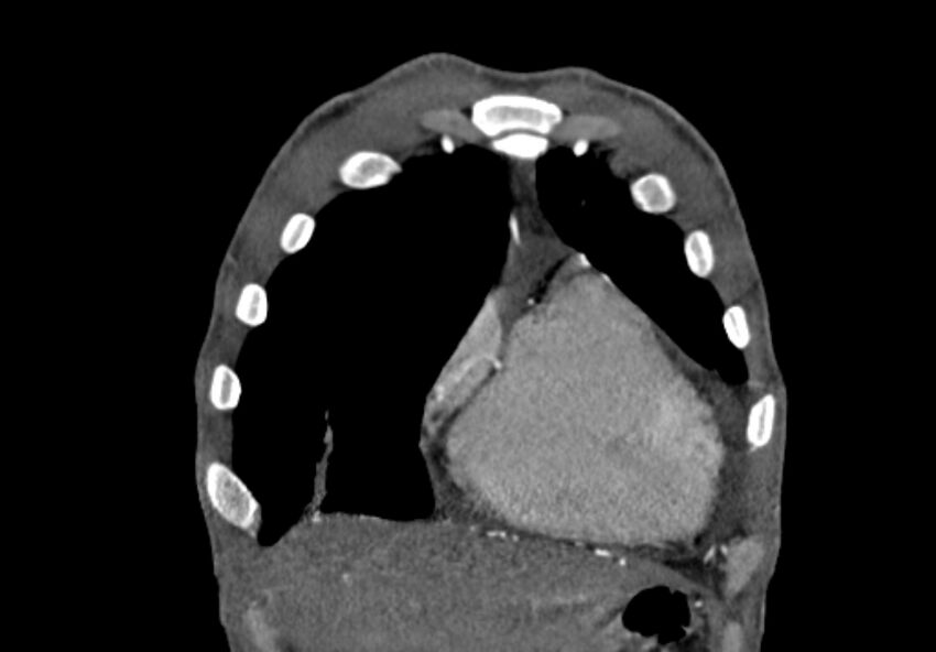 Coarctation of aorta with aortic valve stenosis (Radiopaedia 70463-80574 C 20).jpg
