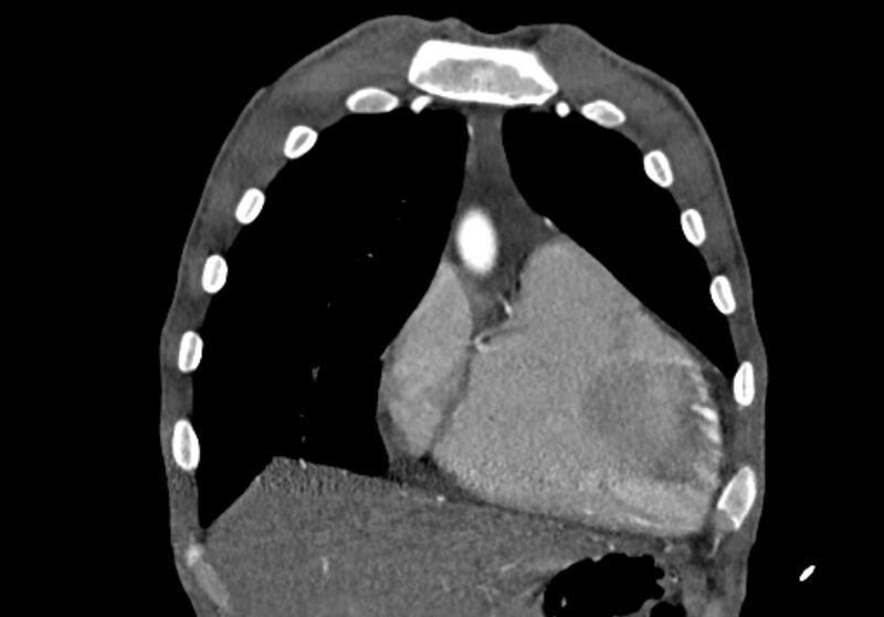 File:Coarctation of aorta with aortic valve stenosis (Radiopaedia 70463-80574 C 34).jpg