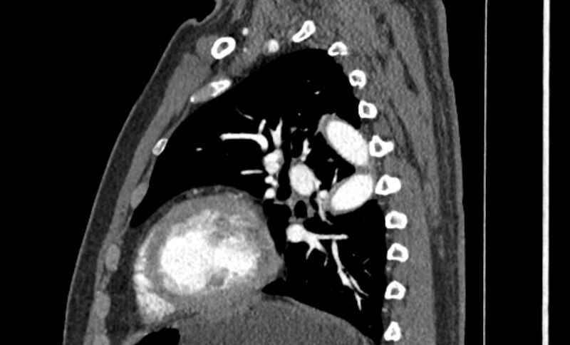File:Coarctation of the aorta (Radiopaedia 53363-59343 B 46).jpg