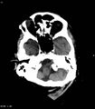 Colloid cyst (Radiopaedia 10638-11100 Axial non-contrast 2).jpg