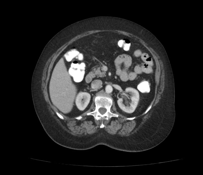 File:Colonic diverticulosis (Radiopaedia 22934-22957 A 26).jpg