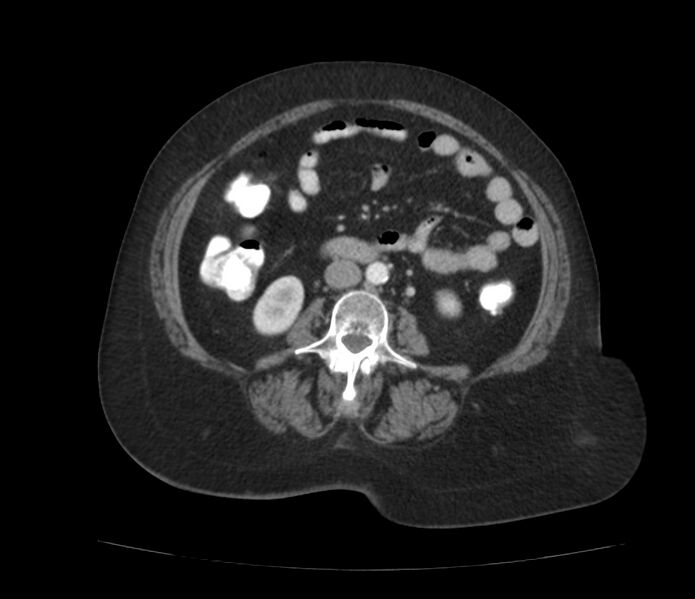 File:Colonic diverticulosis (Radiopaedia 22934-22957 A 37).jpg