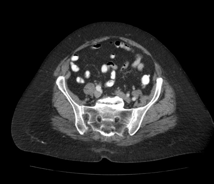 File:Colonic diverticulosis (Radiopaedia 22934-22957 A 54).jpg