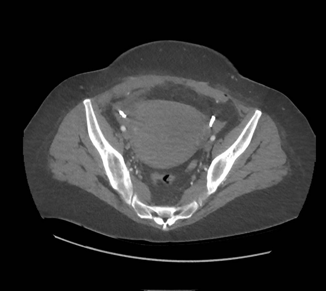 File:Colonic pseudo-obstruction (Radiopaedia 79752-92980 A 157).png