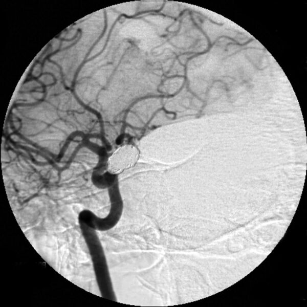 File:Duplicated middle cerebral artery (Radiopaedia 6095).jpg