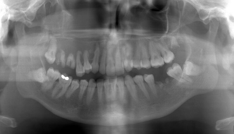 File:Floating teeth (Radiopaedia 74638).JPG