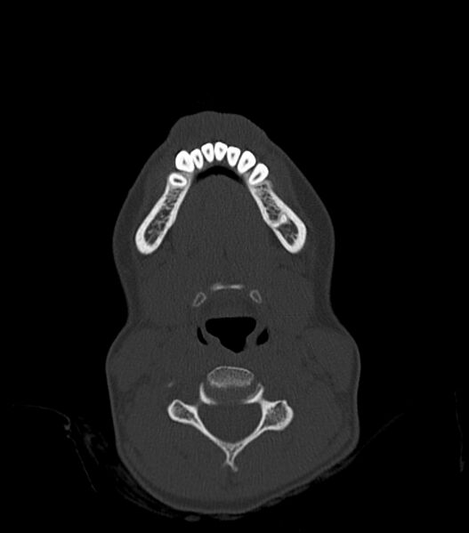 File:Nasoorbitoethmoid fracture (Radiopaedia 90044-107205 Axial bone window 25).jpg
