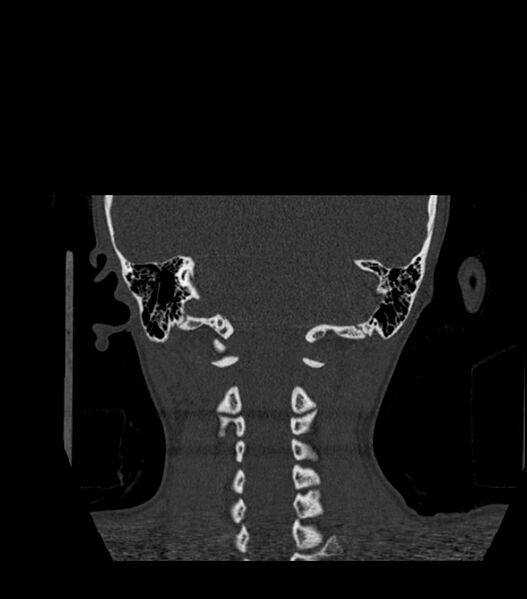 File:Nasoorbitoethmoid fracture (Radiopaedia 90044-107205 Coronal bone window 116).jpg