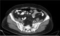 Necrotizing pancreatitis (Radiopaedia 20595-20495 A 35).jpg