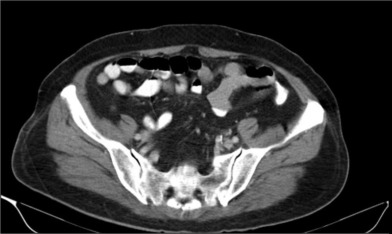 File:Necrotizing pancreatitis (Radiopaedia 20595-20495 A 35).jpg