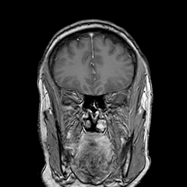File:Neurofibromatosis type 2 (Radiopaedia 67470-76871 Coronal T1 C+ 8).jpg