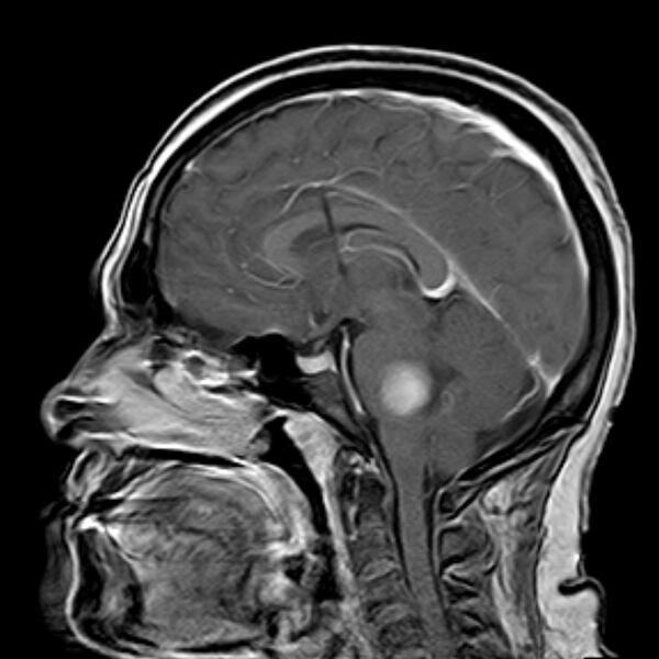 File:Neurofibromatosis type 2 (Radiopaedia 67470-76871 Sagittal T1 C+ 9).jpg