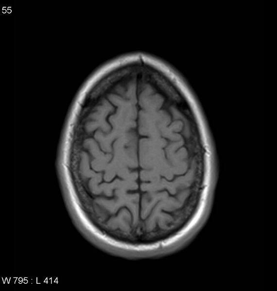 File:Neurosarcoidosis (Radiopaedia 10930-11351 Axial T1 17).jpg