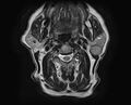 Non-Hodgkin lymphoma - parotid gland (Radiopaedia 71531-81890 Axial T2 10).jpg