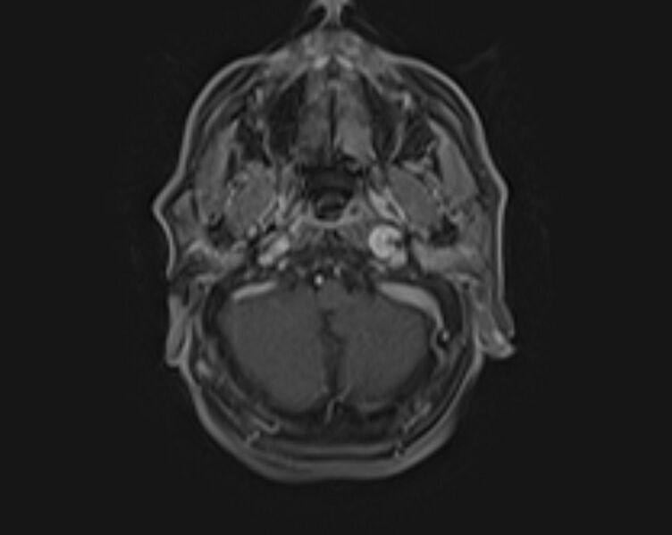 File:Non-Hodgkin lymphoma - parotid gland (Radiopaedia 71531-81890 E 43).jpg