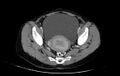 Non-puerperal uterine inversion (Radiopaedia 78343-91094 A 25).jpg